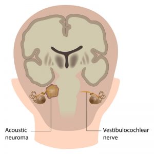 Лечение акустической невриномы в Израиле