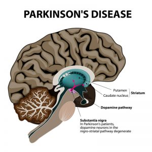 Болезнь Паркинсона - нейроны